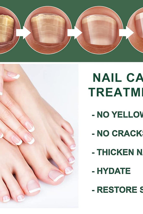 Nail Fungus Treatment Oil (Imported)