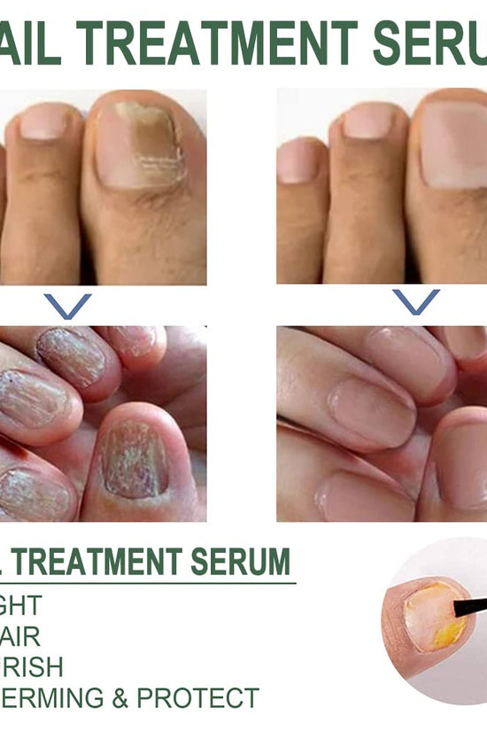 Nail Fungus Treatment Oil (Imported)