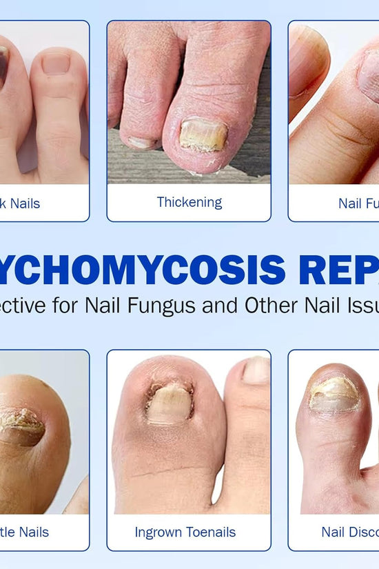 Nighttime Renewal Fungal Nail Patches