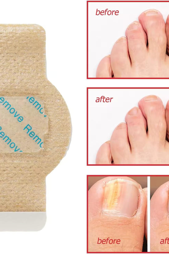 Nighttime Renewal Fungal Nail Patches